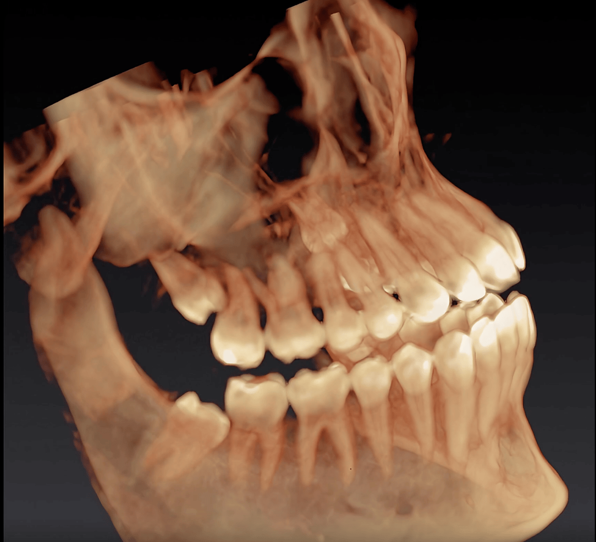 Dental X-ray showing wisdom teeth — Agoura Hills Dental Designs