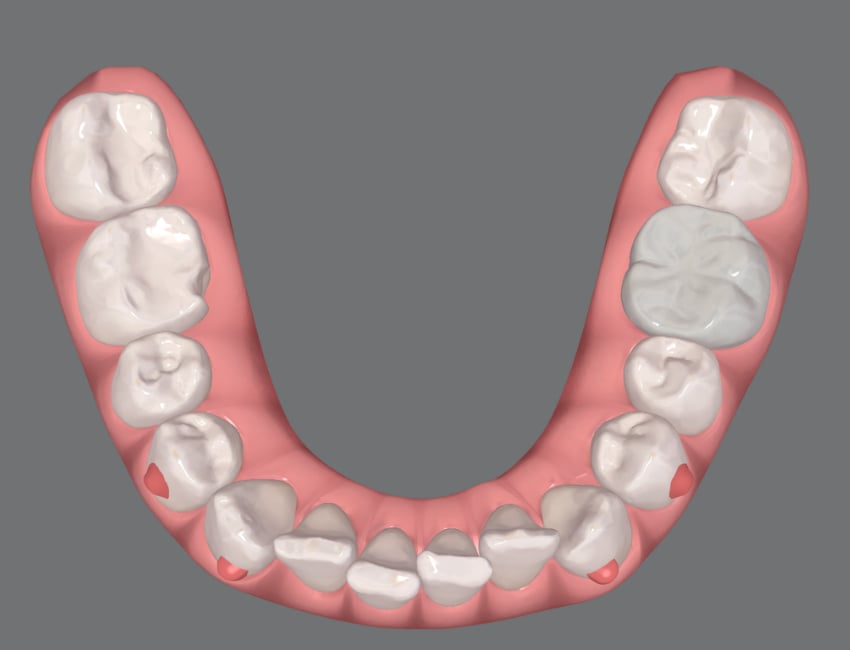 Patient smile before Invisalign treatment