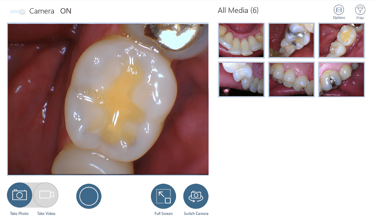 HD intraoral camera in clinical use